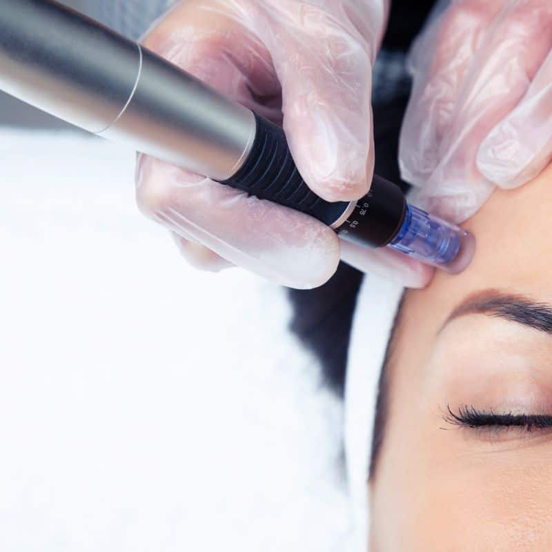 Morpheus8 treatment Sedgley from Lipo Sculpt - Book in today!