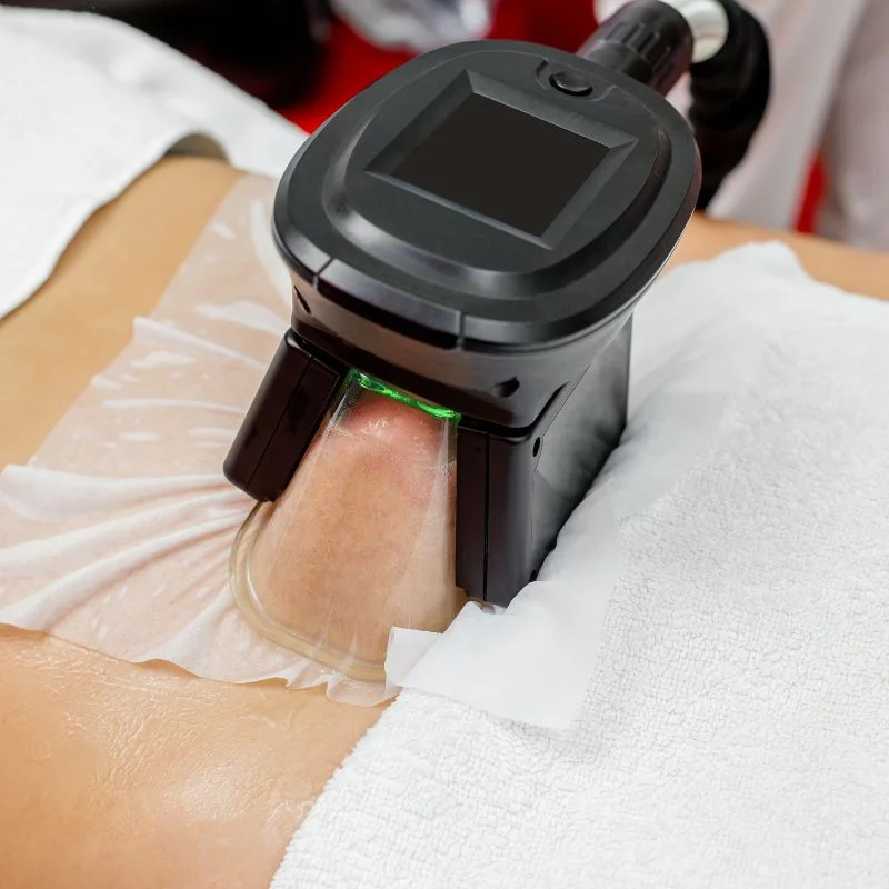 Fat Freezing treatment Sedgley